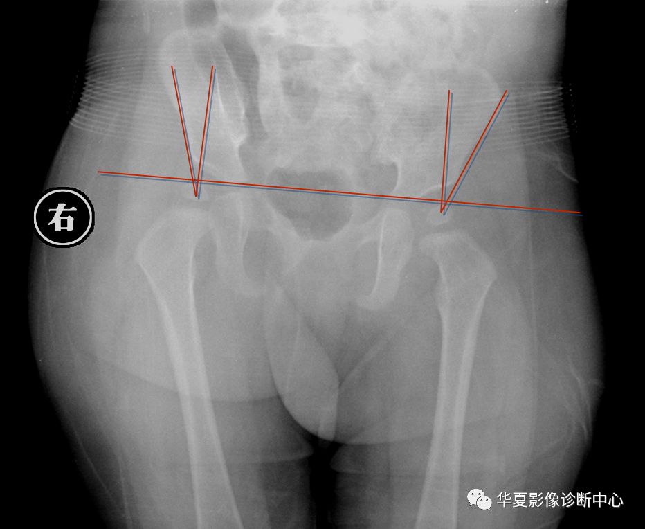 先天性髋关节脱位饮食,先天性髋关节脱位属不属于残疾人