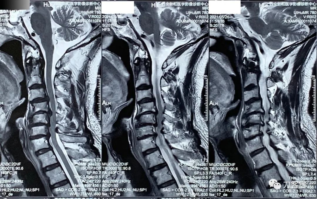 颈椎病椎间盘突出医生说先不手术,颈椎3-7节椎间盘突出怎么治疗