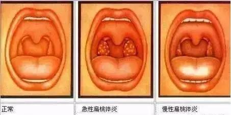 扁桃体容易发炎可以割掉吗,扁桃体老是发炎怎么彻底根治