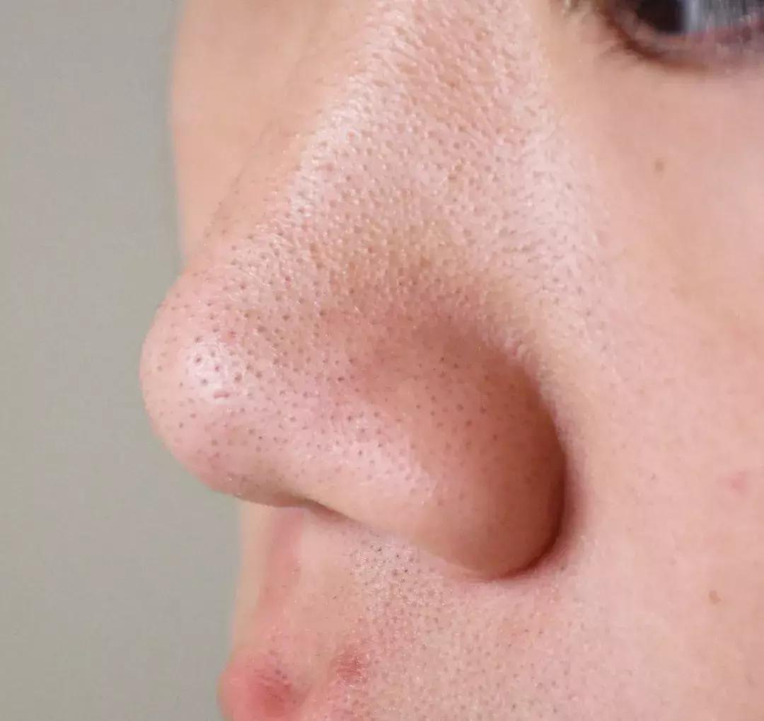 鼻子黑头清洁面膜哪个牌子好,哪种清洁面膜祛黑头粉刺有效果