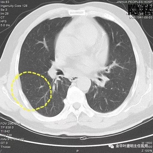 警惕-会是简单的肺大泡吗？