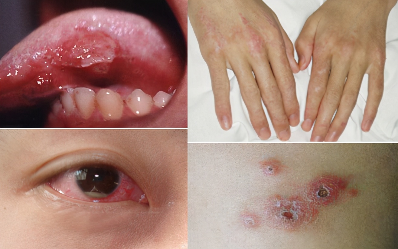 湿热互结引起的口腔溃疡会变成白塞氏病吗？