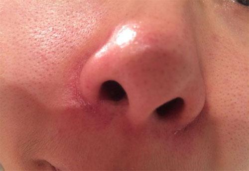 鼻子挤出螨虫怎么消除,鼻子上很多螨虫颗粒怎么解决