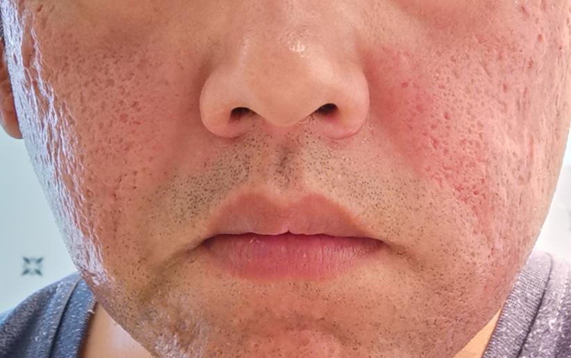 痘坑痘印何须愁眉不展,在家解决!一个40岁战痘老男人的经验分享