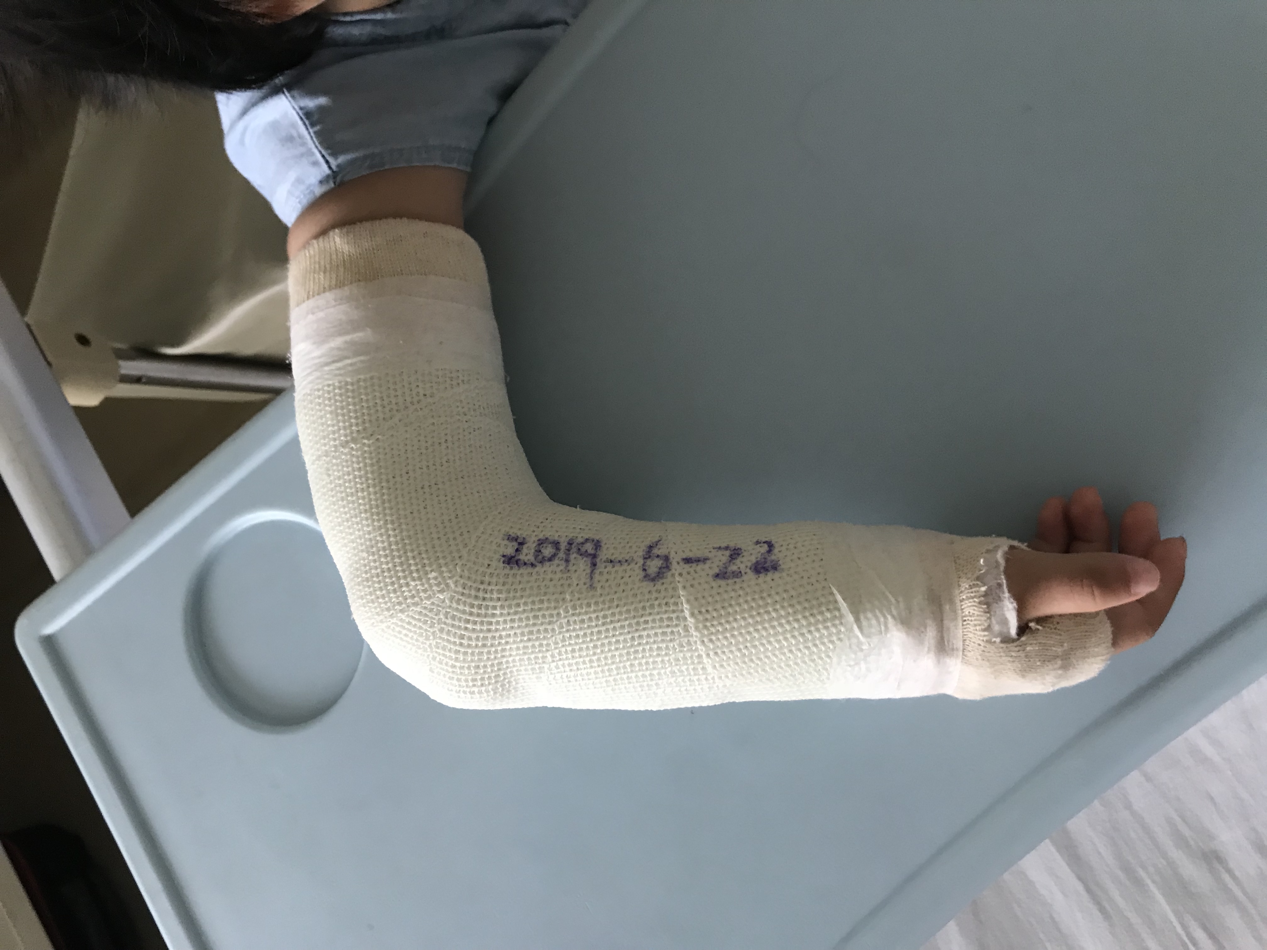 打石膏需要注意事项,打石膏一般要注意什么