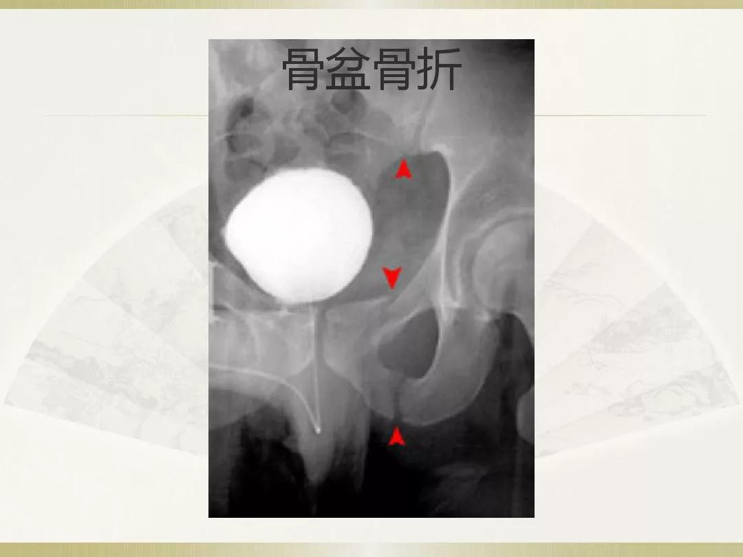 骨科x光片读片技巧,放射科骨科读片教程