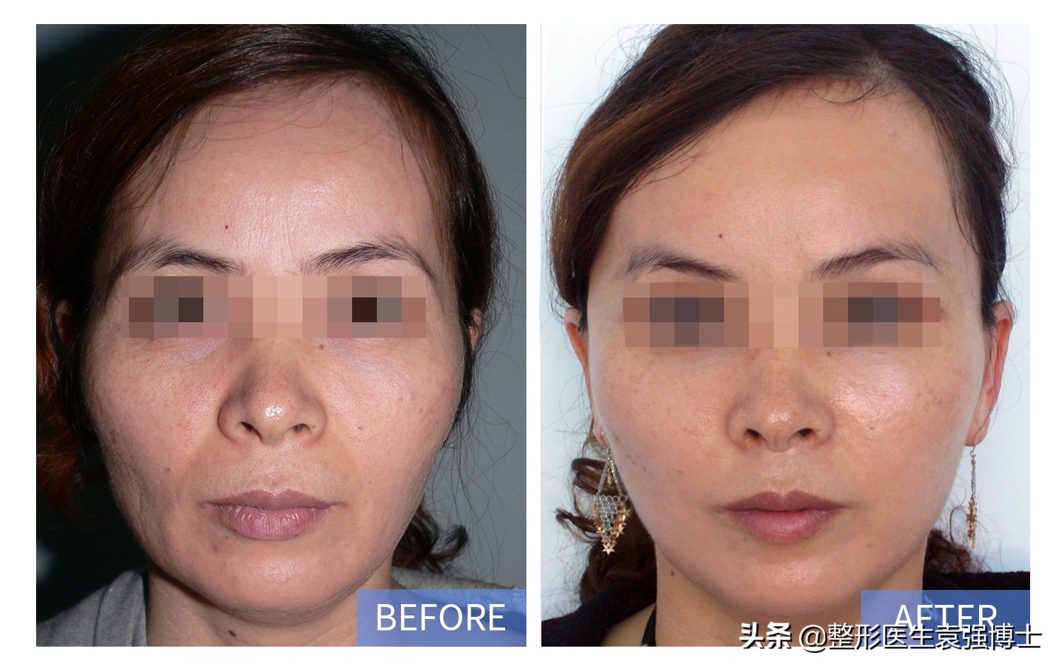 去掉法令纹最好的方法的视频,不用任何化妆品去掉眼部法令纹