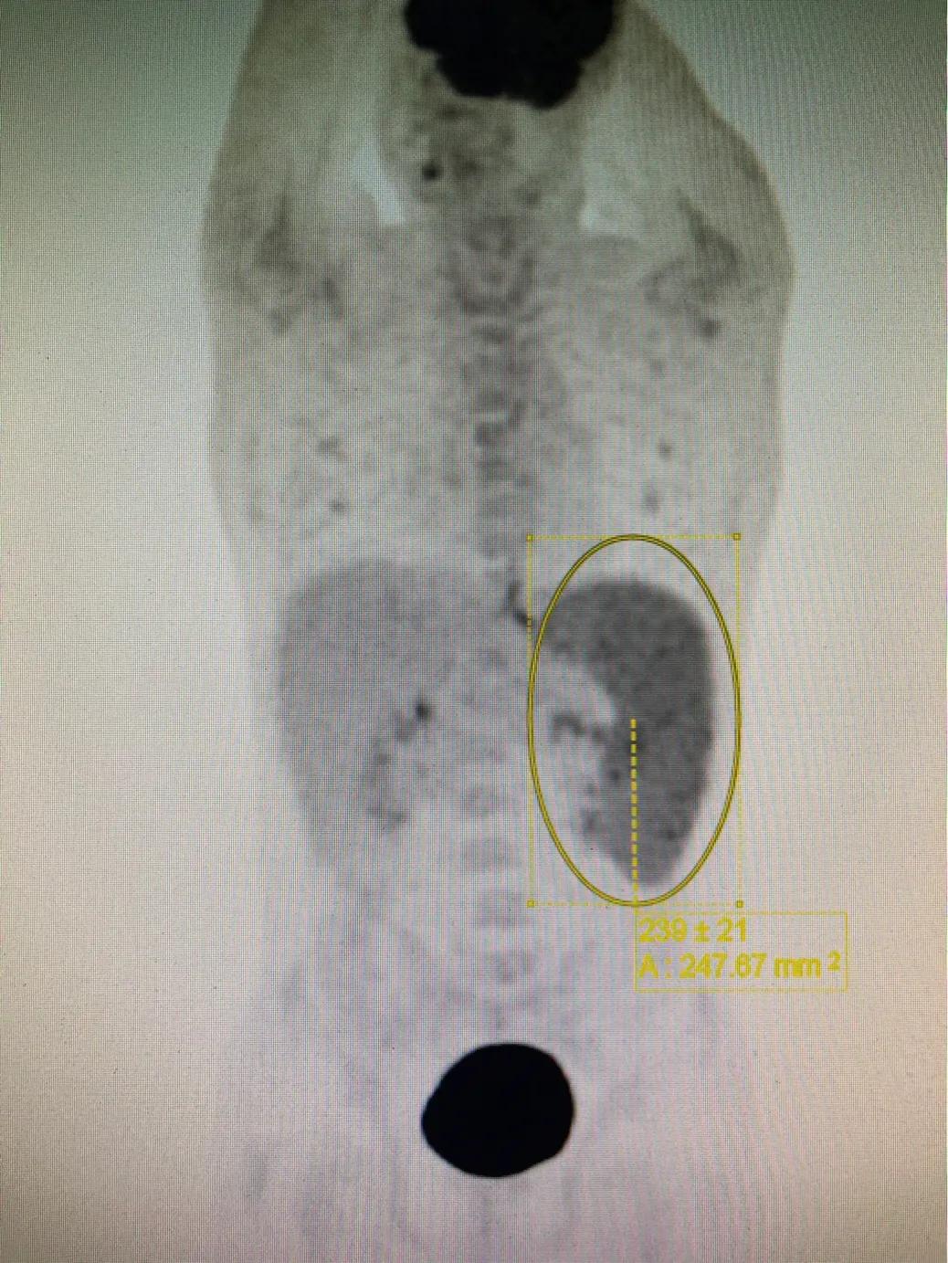 南方有黑热病,北京有黑热病么