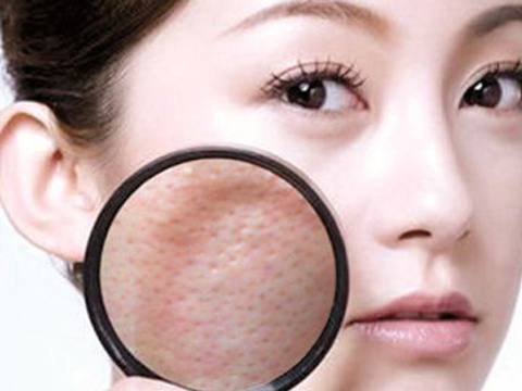 打败毛孔！下一个反孔精英就是你！