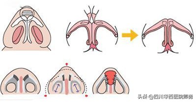 鼻中隔耳软骨隆鼻有哪些优缺点,鼻中隔隆鼻是取鼻中隔软骨吗