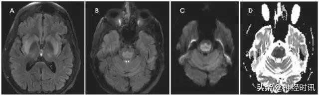 脑卒中病历诊断书图片,脑卒中影像判断技巧图解电子版