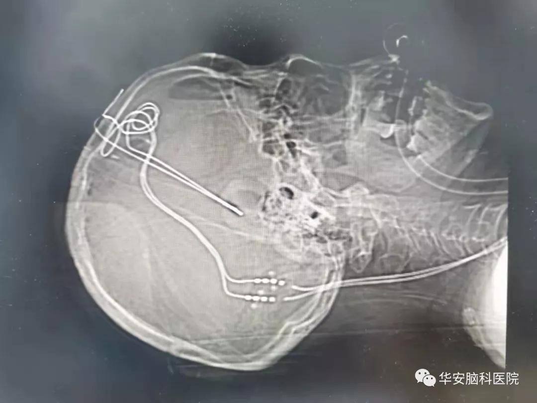 梅杰综合征dbs手术需要开颅吗,梅杰dbs手术住院需要几天