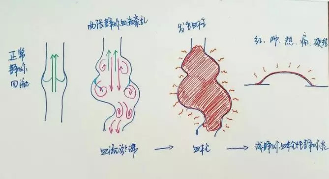 我静脉曲张最近老是疼怎么办,我静脉曲张了应该怎么治疗