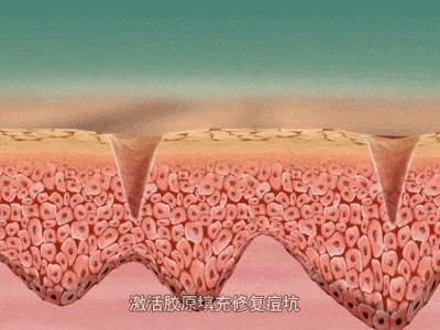 这才是祛痘印最正确的打开方式,全球公认最有效的祛痘印方法