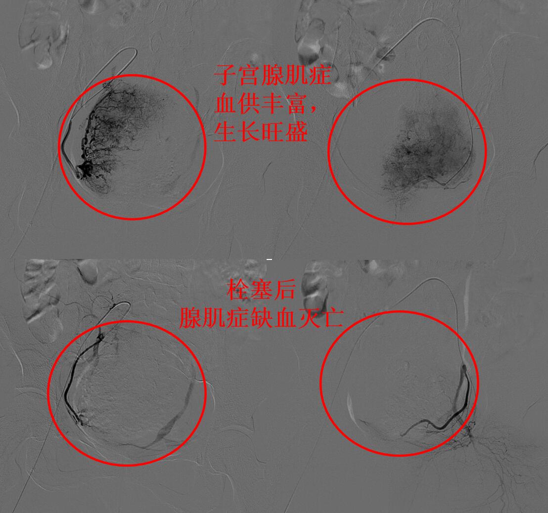 看看痛不欲生的子宫腺肌症痛经专业领域的看法与典型病例