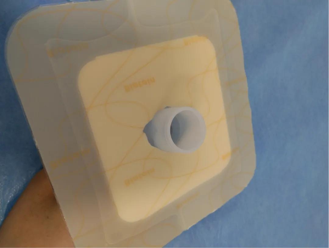 拜尔坦泡沫敷料能促进伤口愈合吗,什么样的病人应该用泡沫敷料