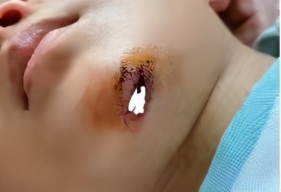 孩子误吞硬币怎么办,孩子误吞硬币怎么解决