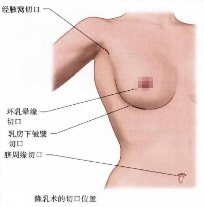 关于假体丰胸的问题,假体隆胸的5个问题