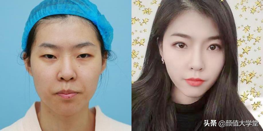 为什么做了双眼皮还不好看,做双眼皮前问清楚自己这三个问题