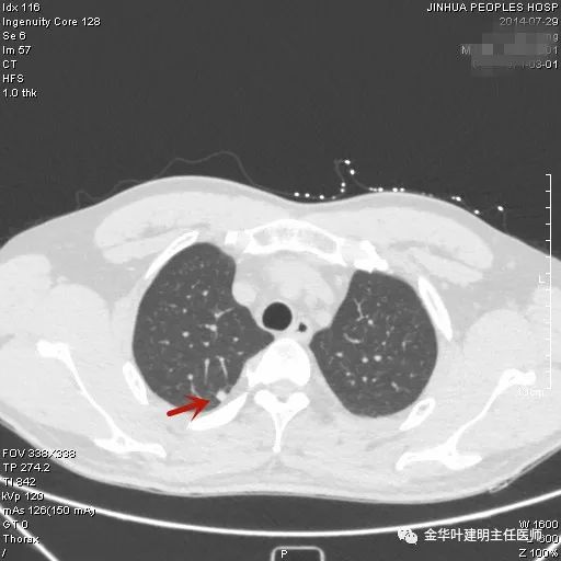 叶建明谈实性结节,叶建明肺实性良性结节会变癌症吗