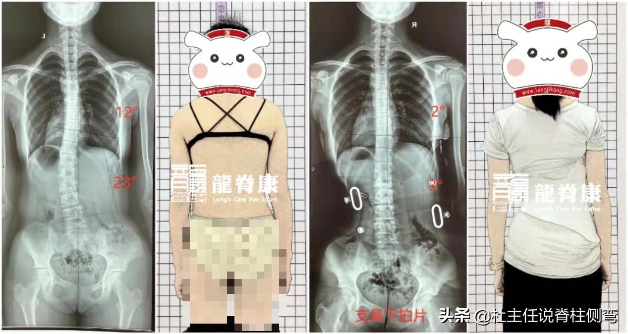 14岁女孩侧弯治疗一年后,12岁女孩脊柱s型侧弯17度怎么治