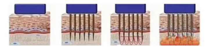 毛孔粗大有痘痘如何改善,毛孔粗大有痘痘的脸怎么办