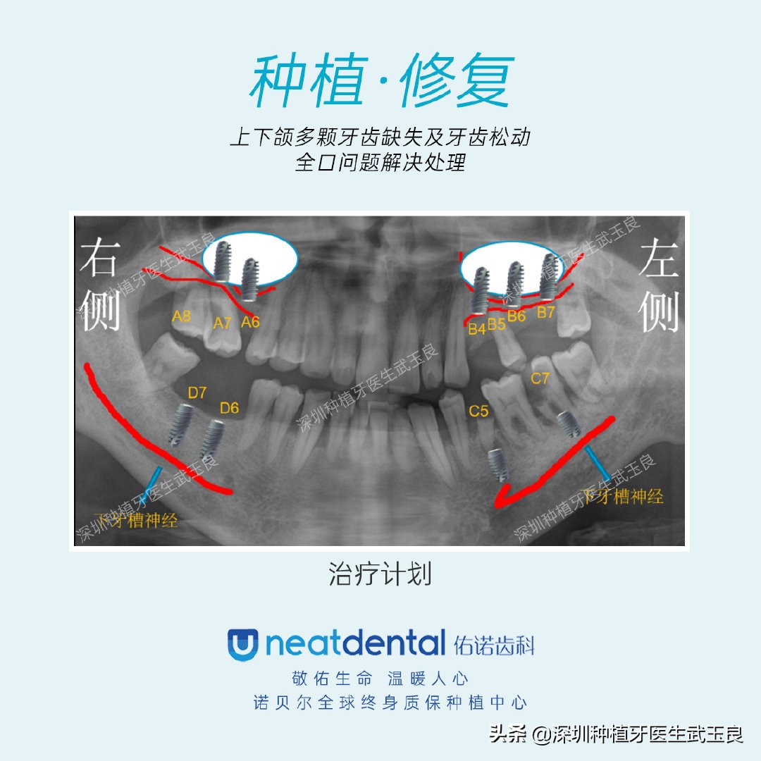 多颗牙齿缺失怎么修复全过程,多颗缺失牙修复案例