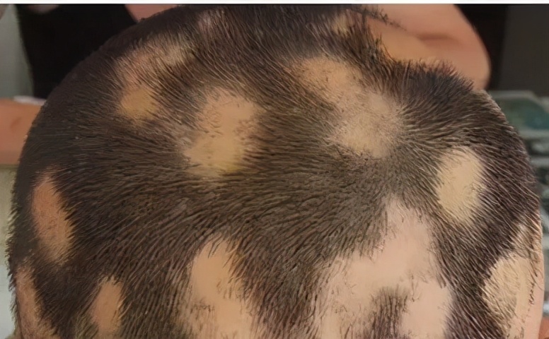 白癜风脱发脱得厉害怎么办,白癜风会导致头发脱落吗