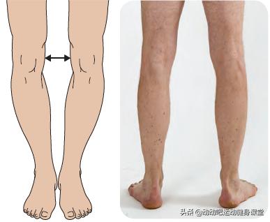 o型腿该怎么拯救,o型腿怎么拯救