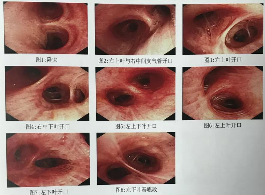 咳嗽10多天了有白痰细菌感染,咳嗽是肺部真菌感染吗