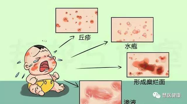 宝宝湿疹和痱子的区别和治疗方法,宝宝痱子湿疹怎么消除效果好