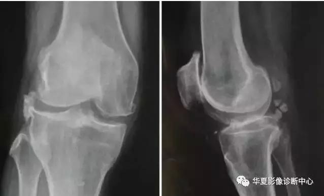 膝关节痛警惕四种病,科普膝关节疼痛影响到的22种疾病