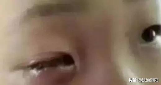 6岁男童眼球险失明,9岁男童眼球失明