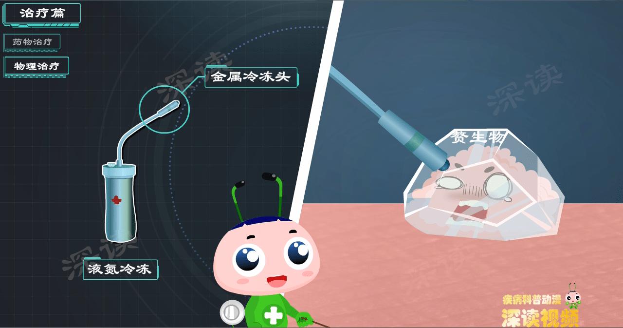 液氮冷冻治疗尖锐疣疼吗 (液氮冷冻治疗尖锐疣几天掉)