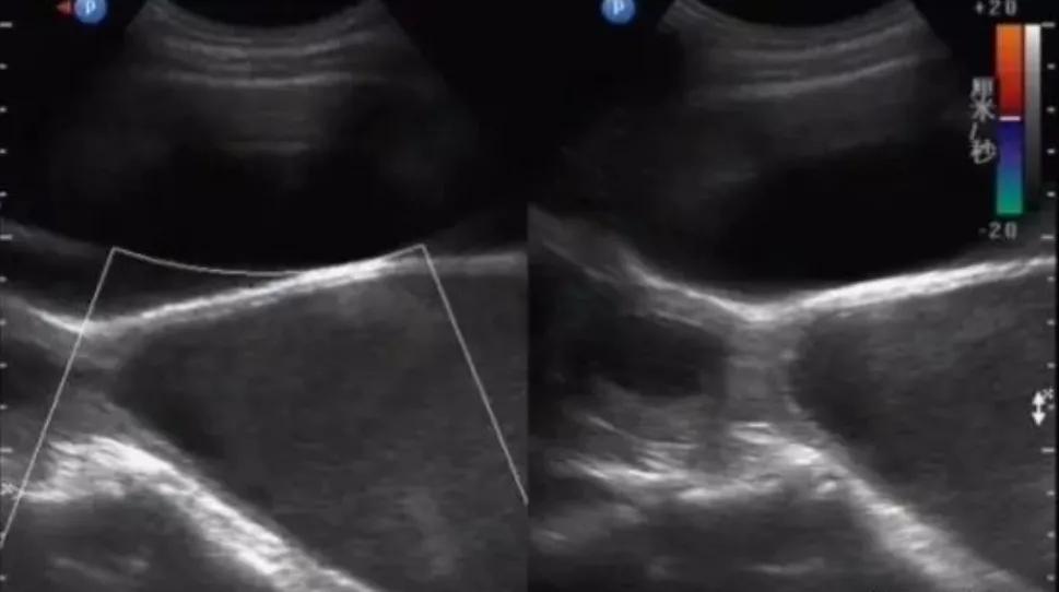 处女的第一次都会流血吗？会不会有例外？一次性科普到位