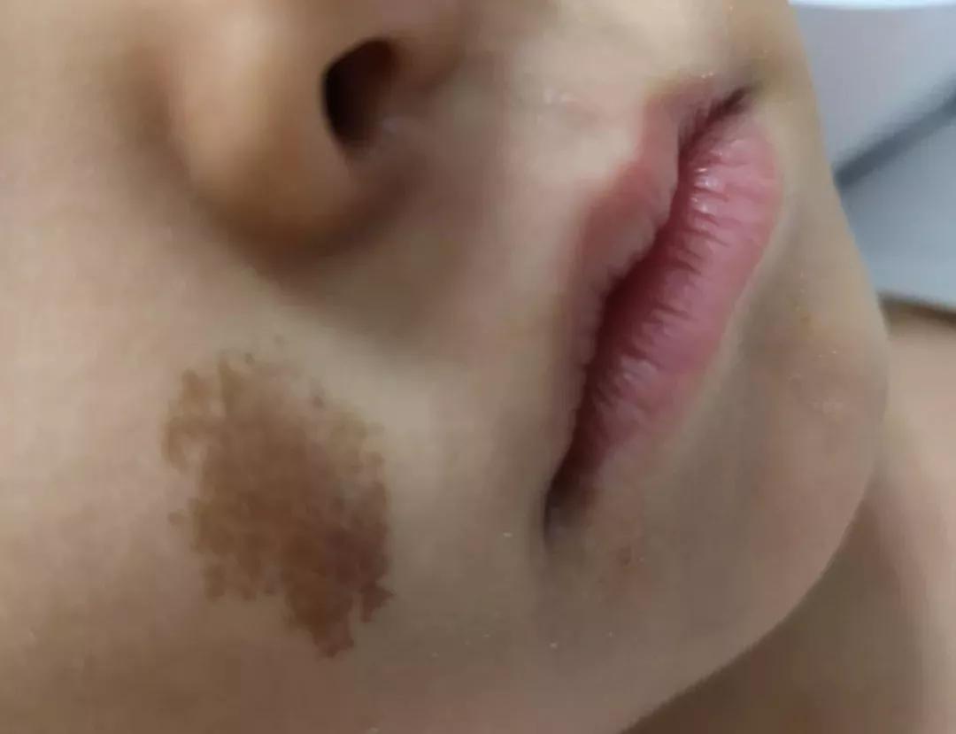 斑治疗越早效果越好,斑有没有办法治