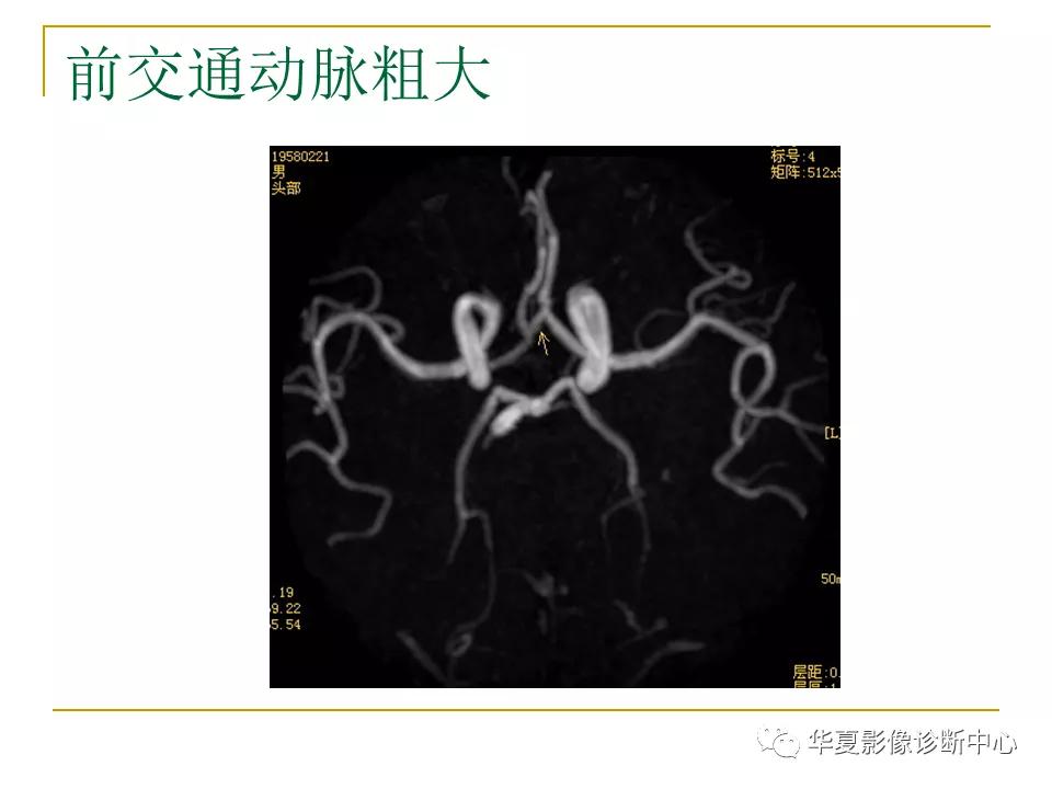中国人脑立体定向mri应用解剖图谱,脑mri示意图