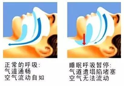 睡觉打呼噜原因和治疗方法,睡觉张嘴打呼噜教你一招轻松解决