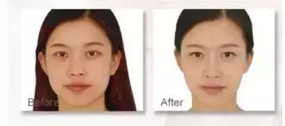 瘦脸针的5个常见问题,瘦脸针其实副作用挺大的