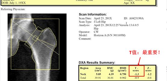 类风湿性关节炎骨质疏松怎么缓解,类风湿和骨质疏松怎么办