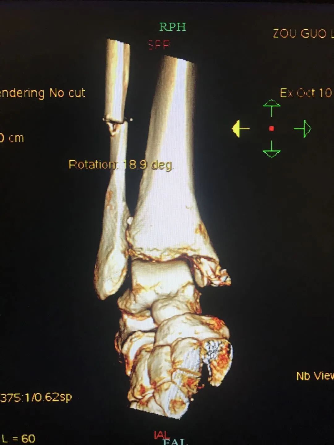 辽宁锦州患者跨数千公里到浙江嵊州只做简单手术背后有个故事