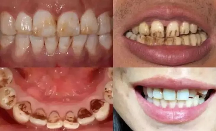 超声波与声波牙刷区别,磁悬浮声波和超声波牙刷哪个好