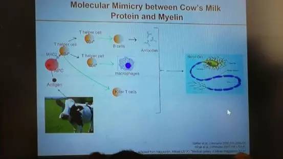多发性硬化患者分享,多发性硬化的病例分享