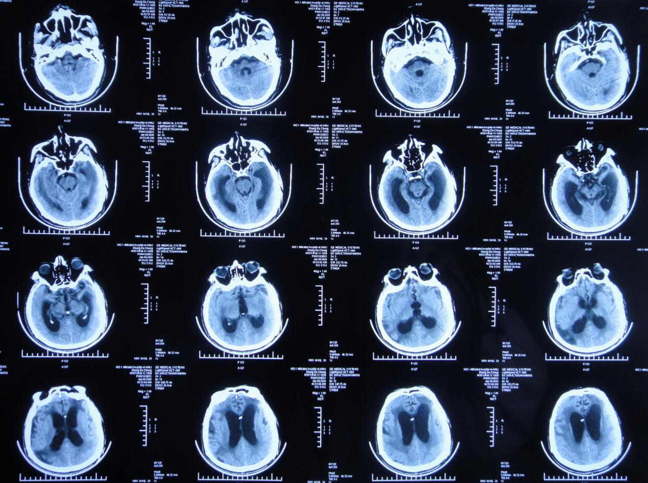 颅脑外伤术后脑积水,脑外伤脑积水颅骨缺失