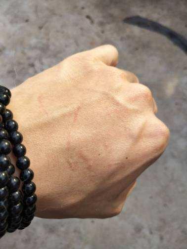 猫狗抓伤最佳处理时间是,猫狗抓伤如何处理伤口