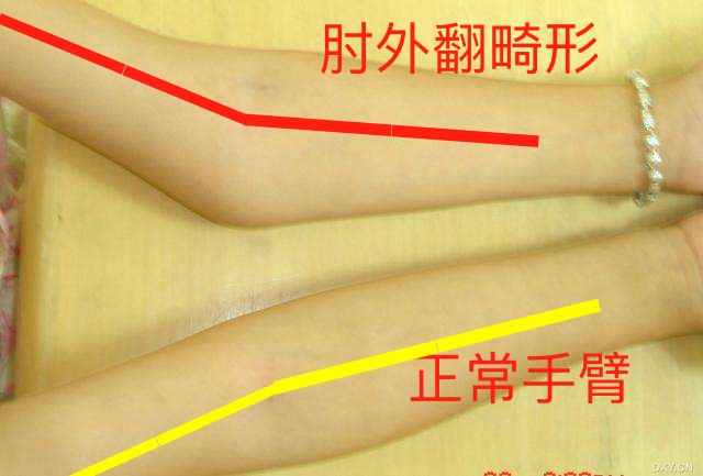 手臂骨折出现畸形愈合怎么处理,手臂骨折复位不正怎么补救