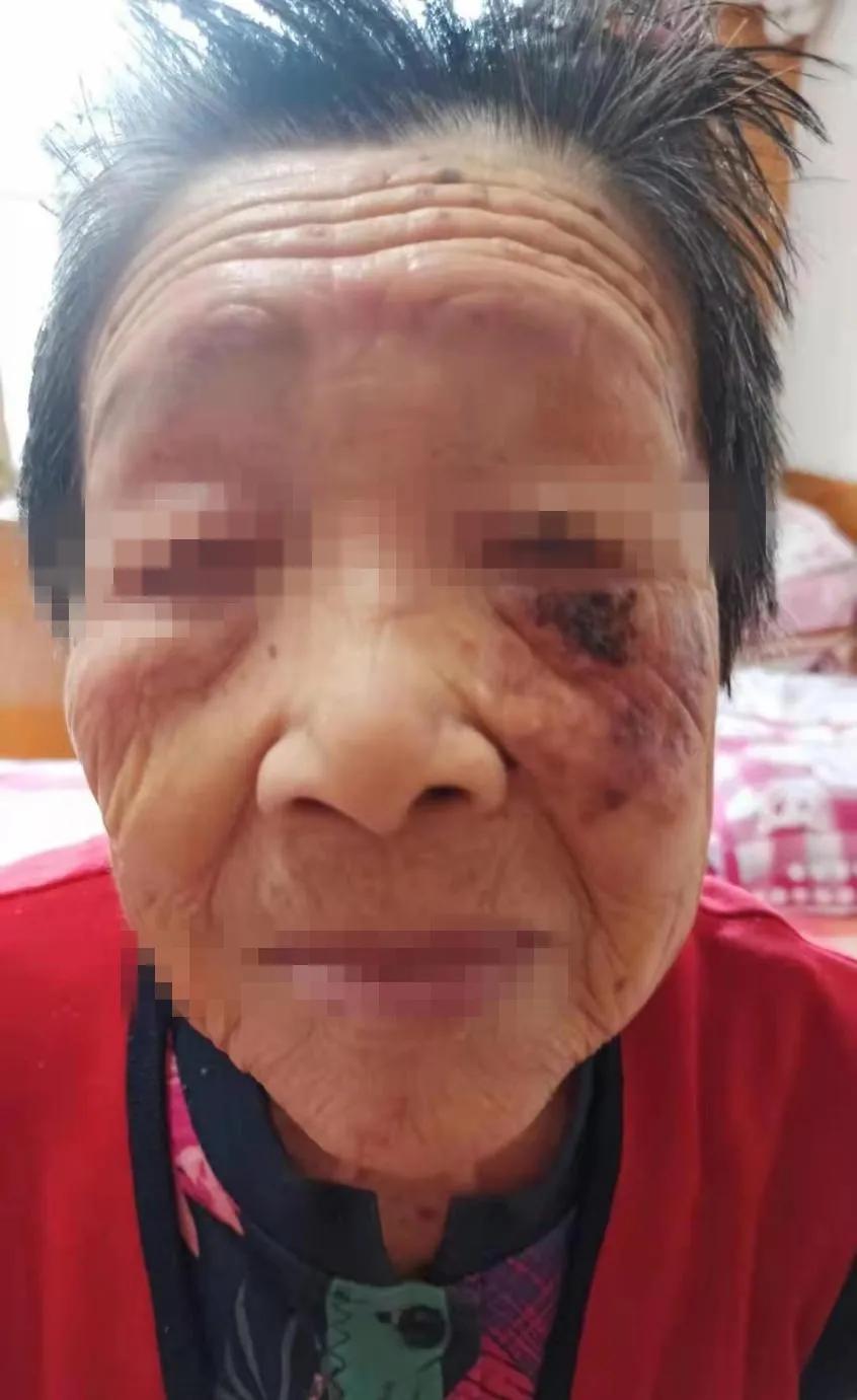 警惕老年斑可能是癌症预兆,什么样的老年斑需要警惕