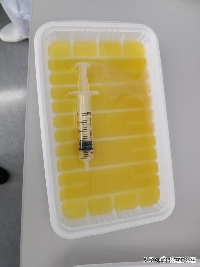 花椒治疗滑膜积液,艾叶生姜花椒敷膝关节积液管用吗