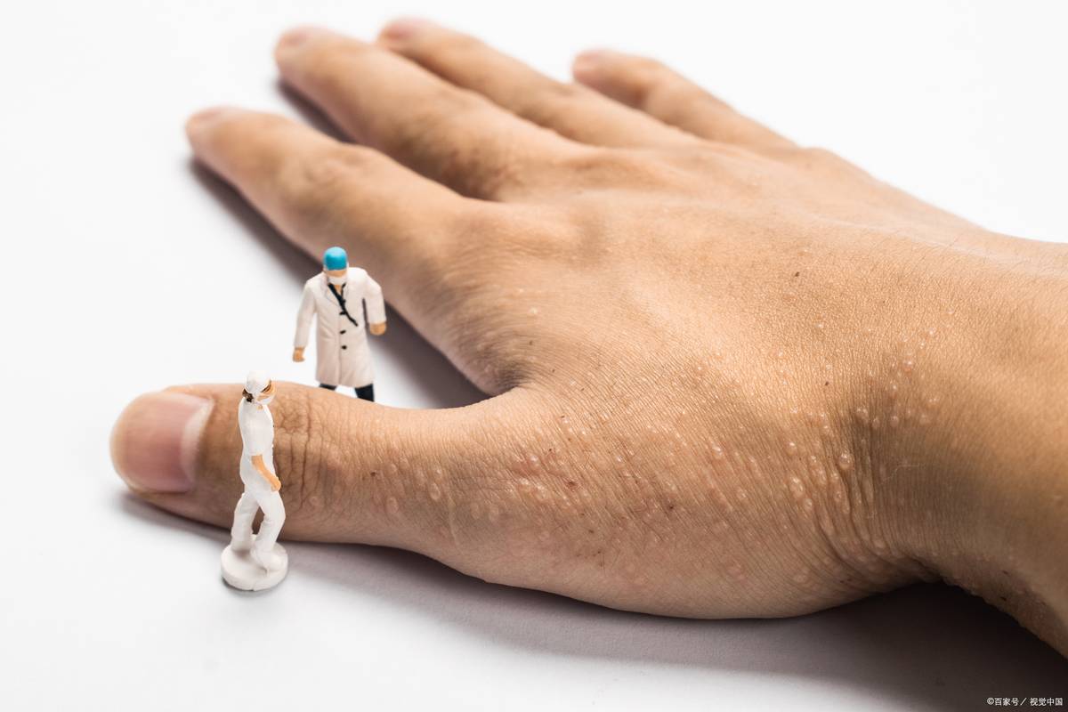 湿疹晚上很痒控制不住挠怎么办,湿疹越挠越痒还有大量红斑