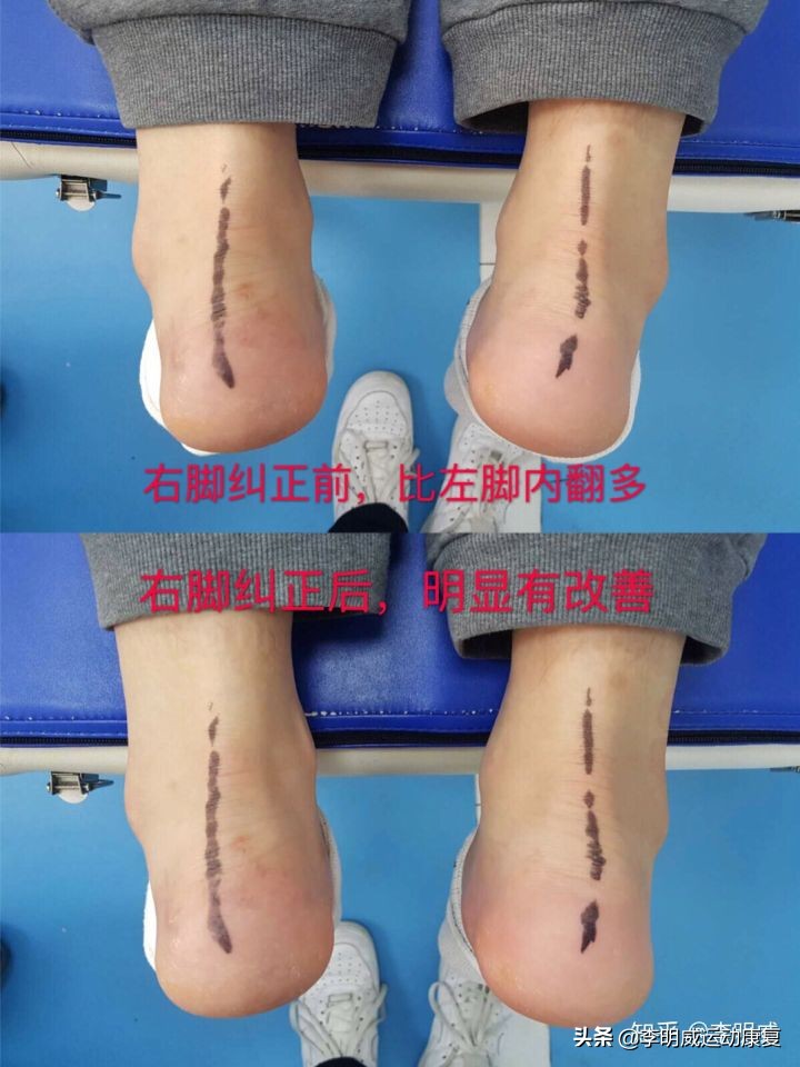站斜板真的能纠正足内翻,矫正足内翻训练